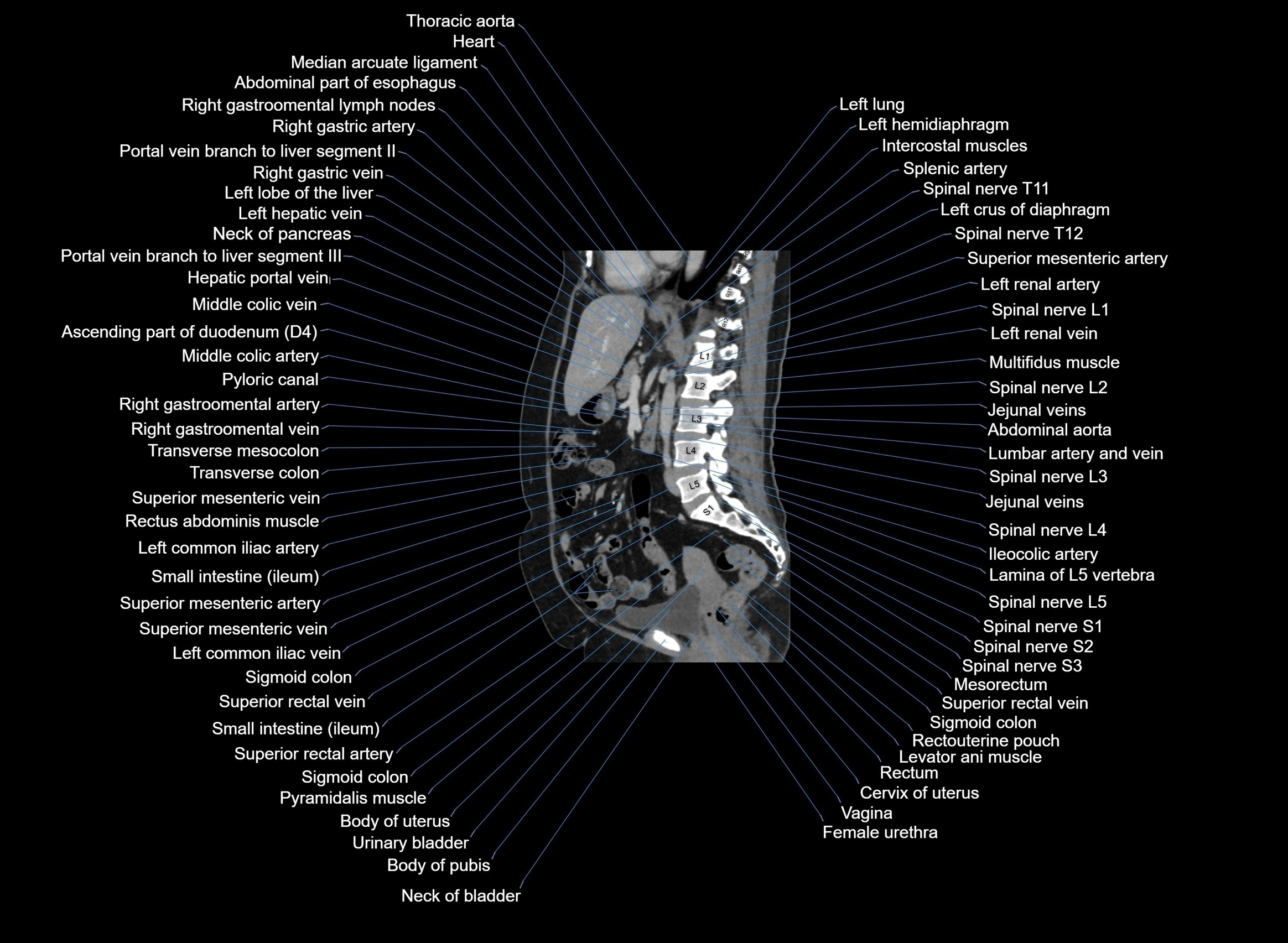 CT Abdomen sagittal cross sectional anatomy labelled radiology image -00056.webp